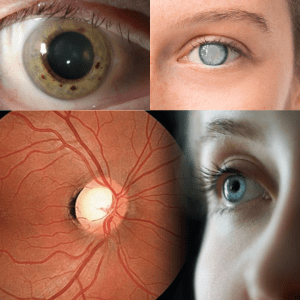 Common Eye Problems Associated with Pneumonia-sanjeevan