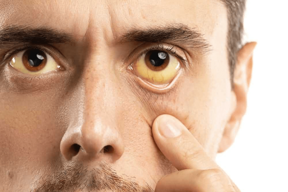 Symptoms of Vision Problems in Pancreatic Cancer Patients Sanjeevan