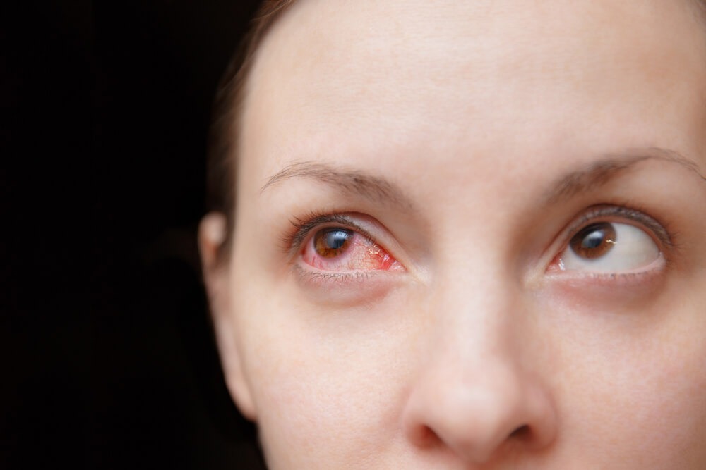 Common Eye Issues During Pregnancy